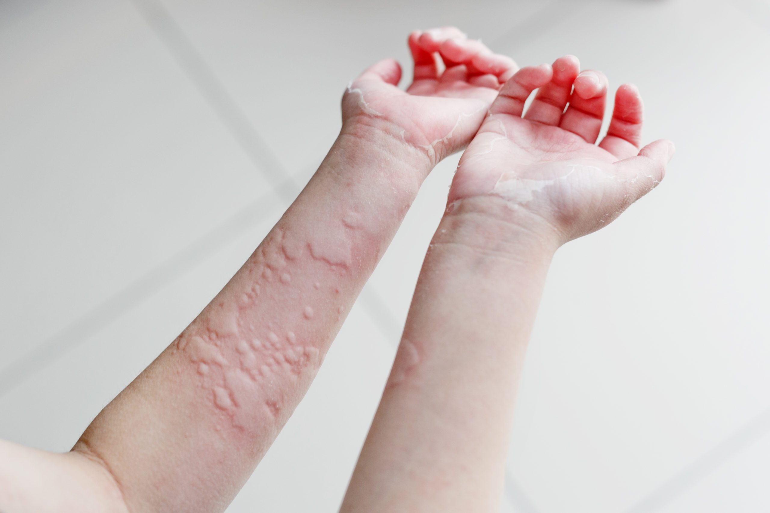Understanding urticaria and angioedema