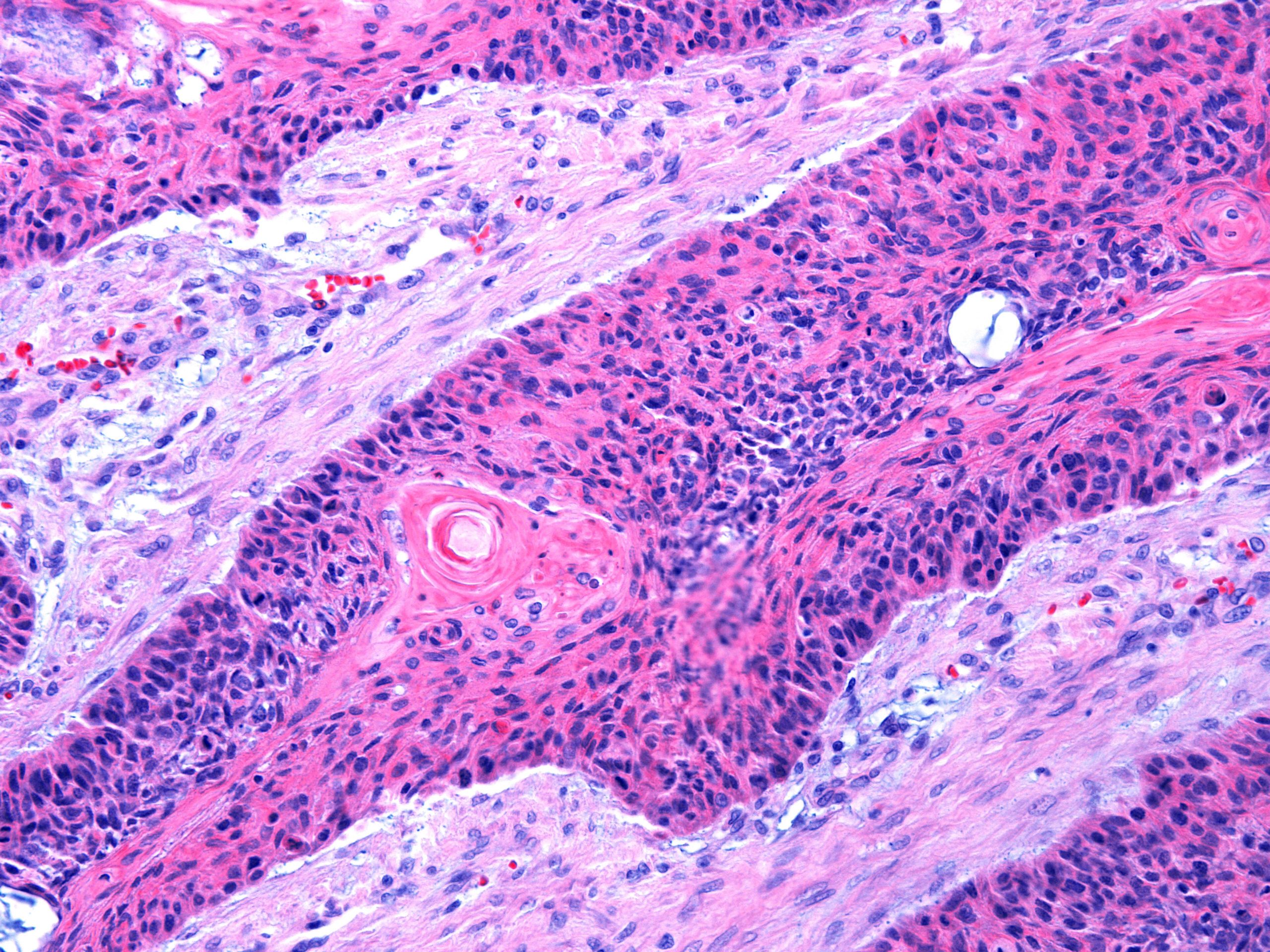 SCCs more deadly in the immunosuppressed
