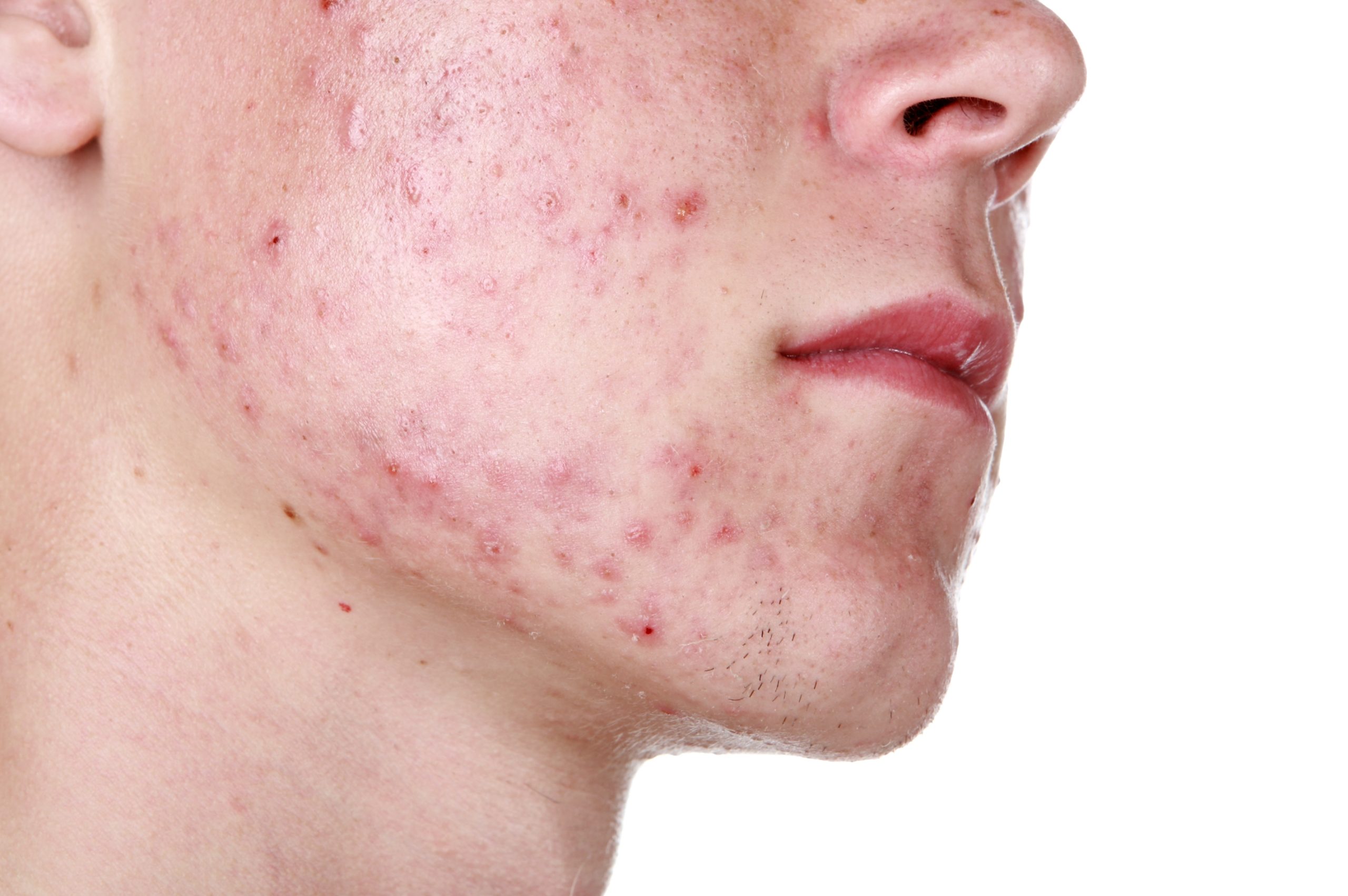 Severe,Acne