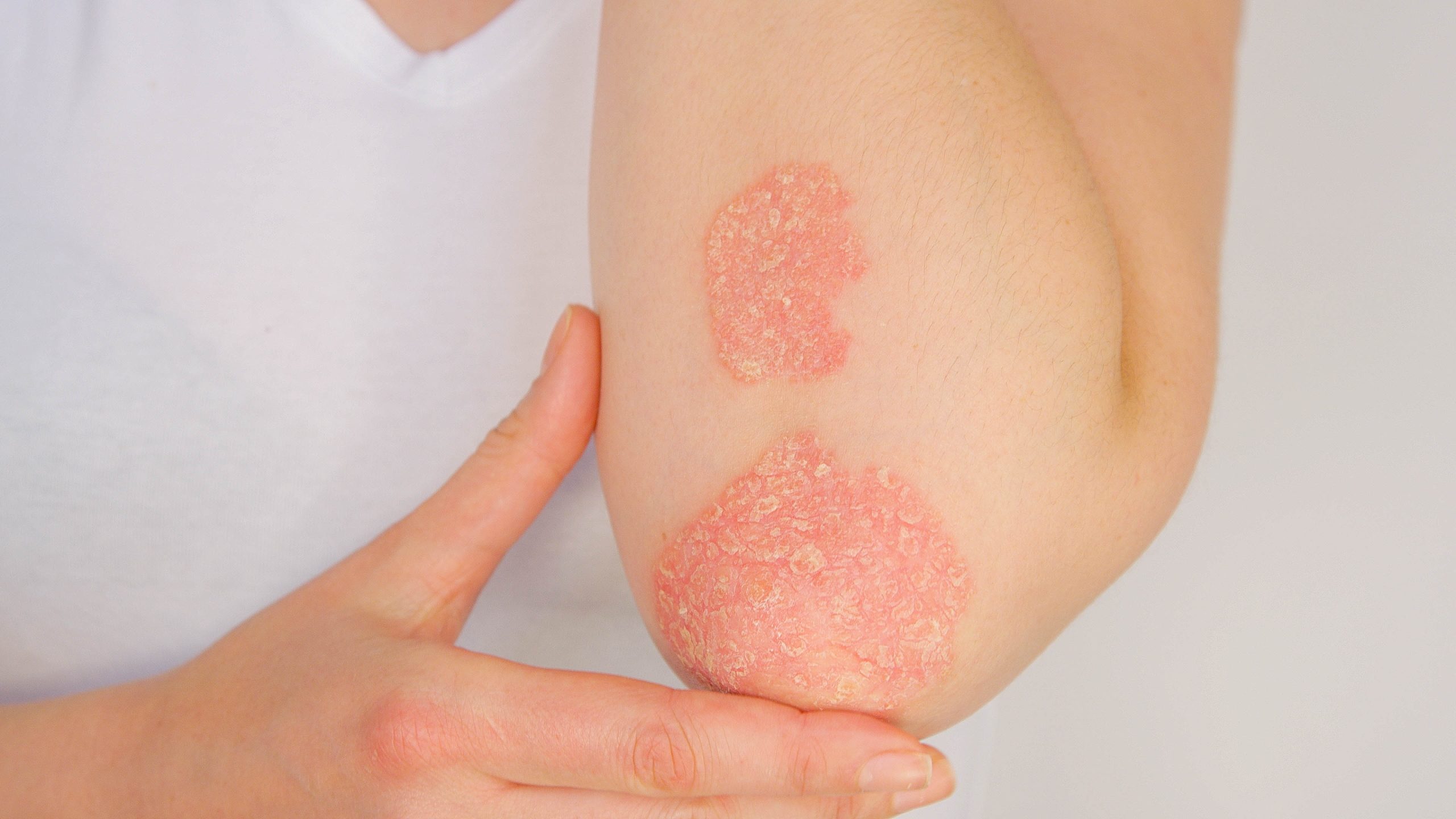Psoriasis-Shutterstock-scaled