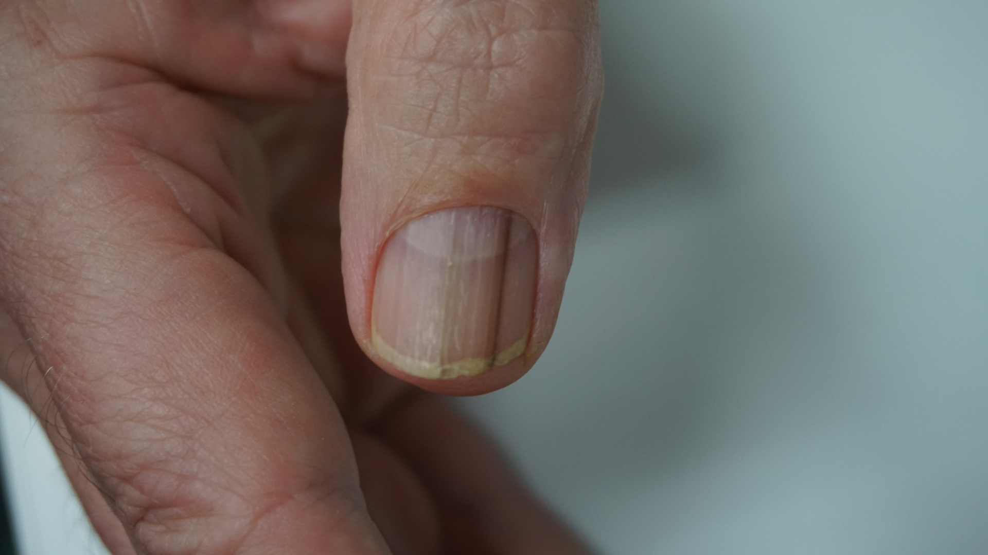 Article Feature Image - Pigmented Streak