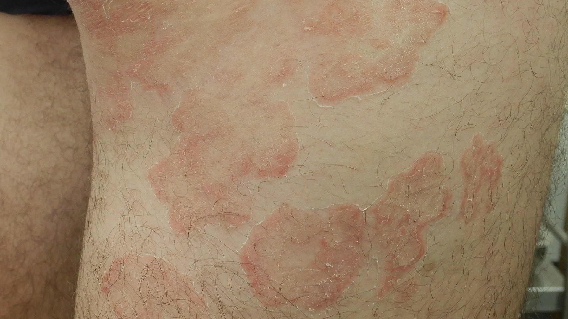 Article Feature Image - Annular scaly plaque