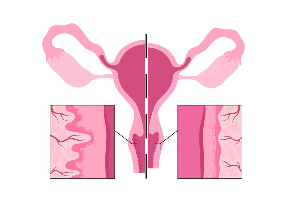 Vaginal atrophy, genitourinary health in older women - Course image