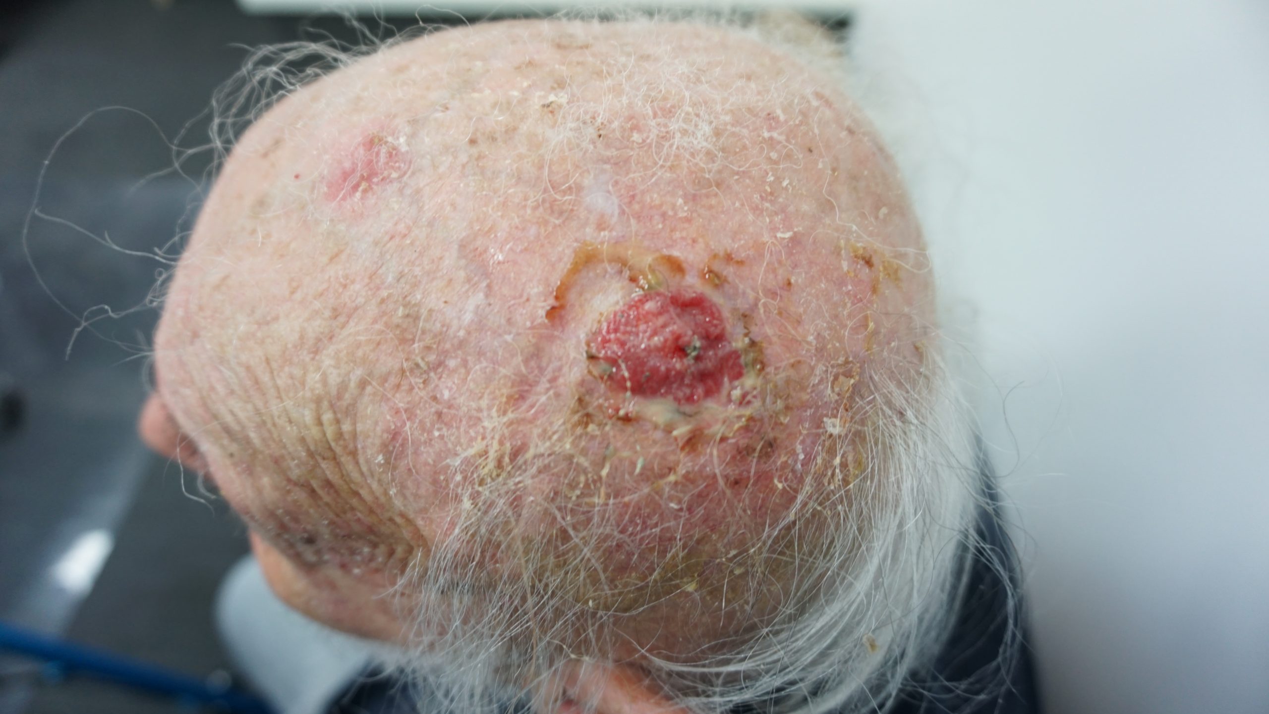 Feb 2025 - Bowen disease