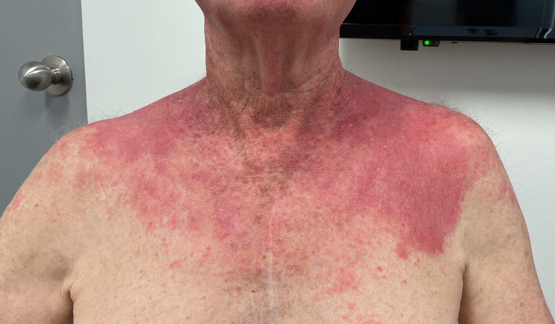 Feb 2025 - Contact Dermatitis