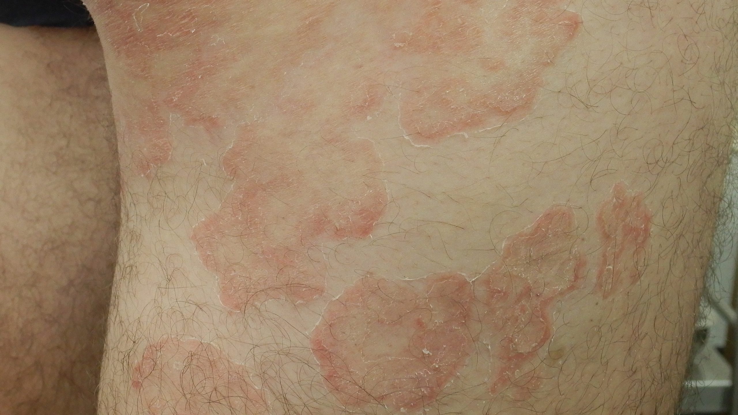 ep 4. red scaly lesions