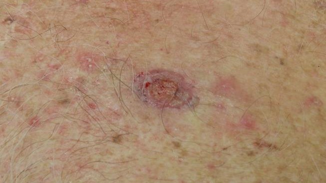 Feb 2025 - chest SCC