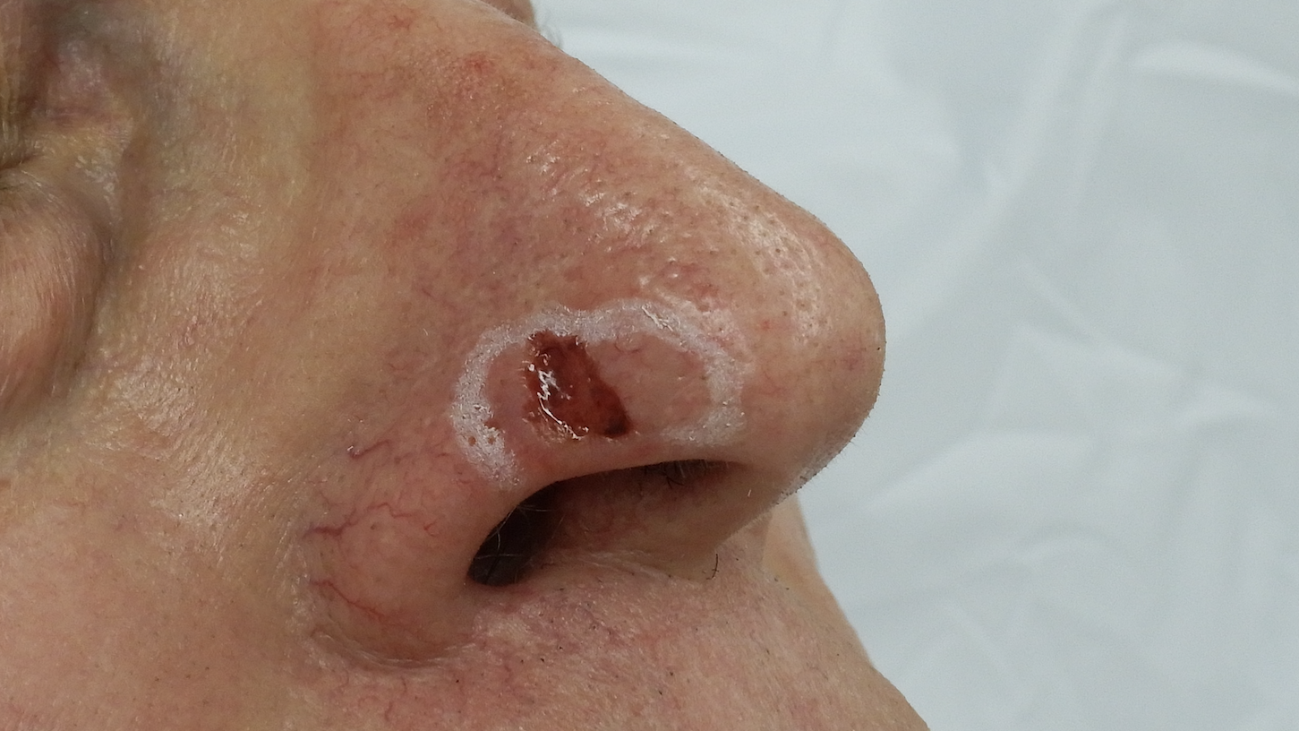 inset ulcer on nose