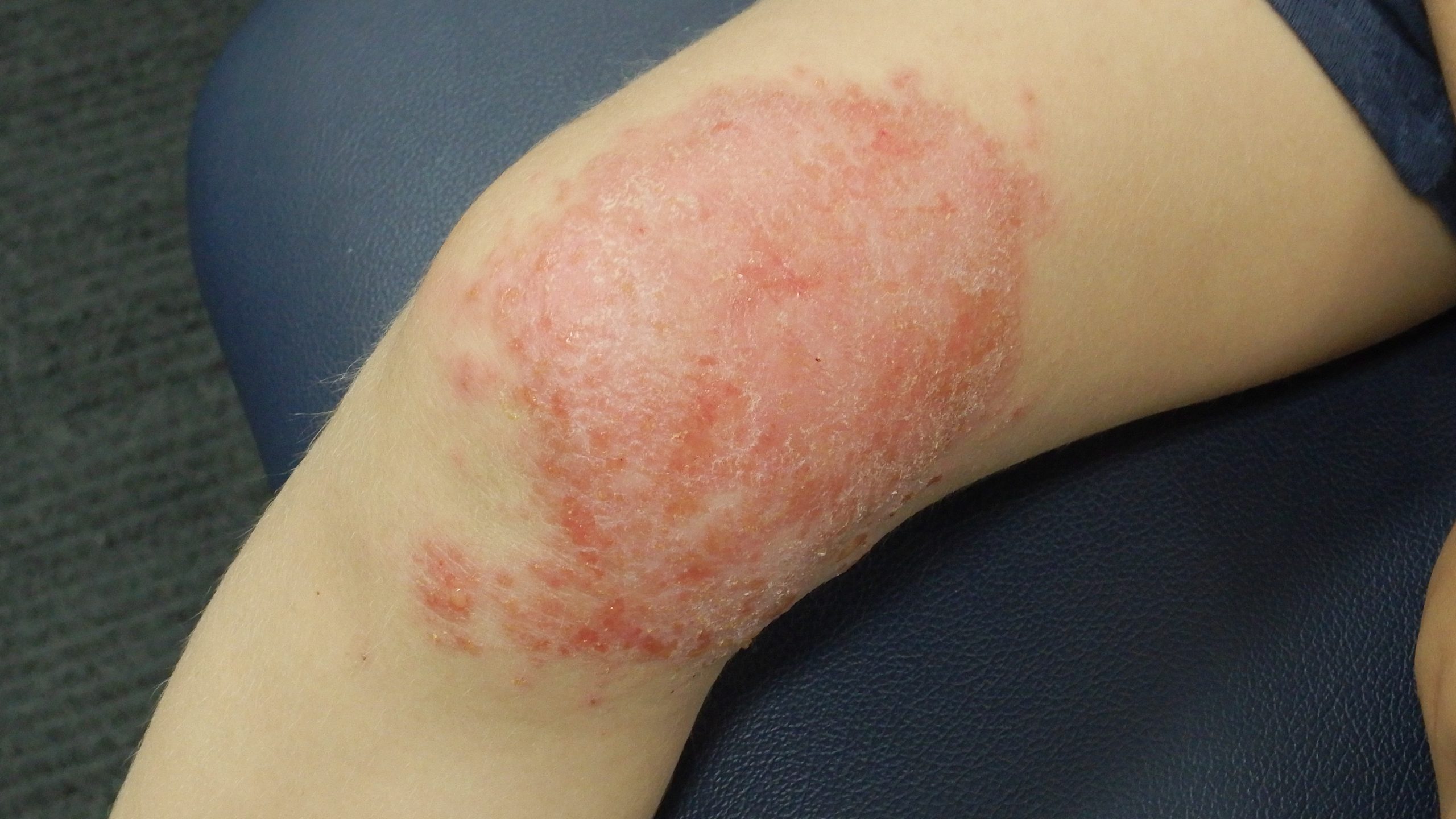 Cellulitis