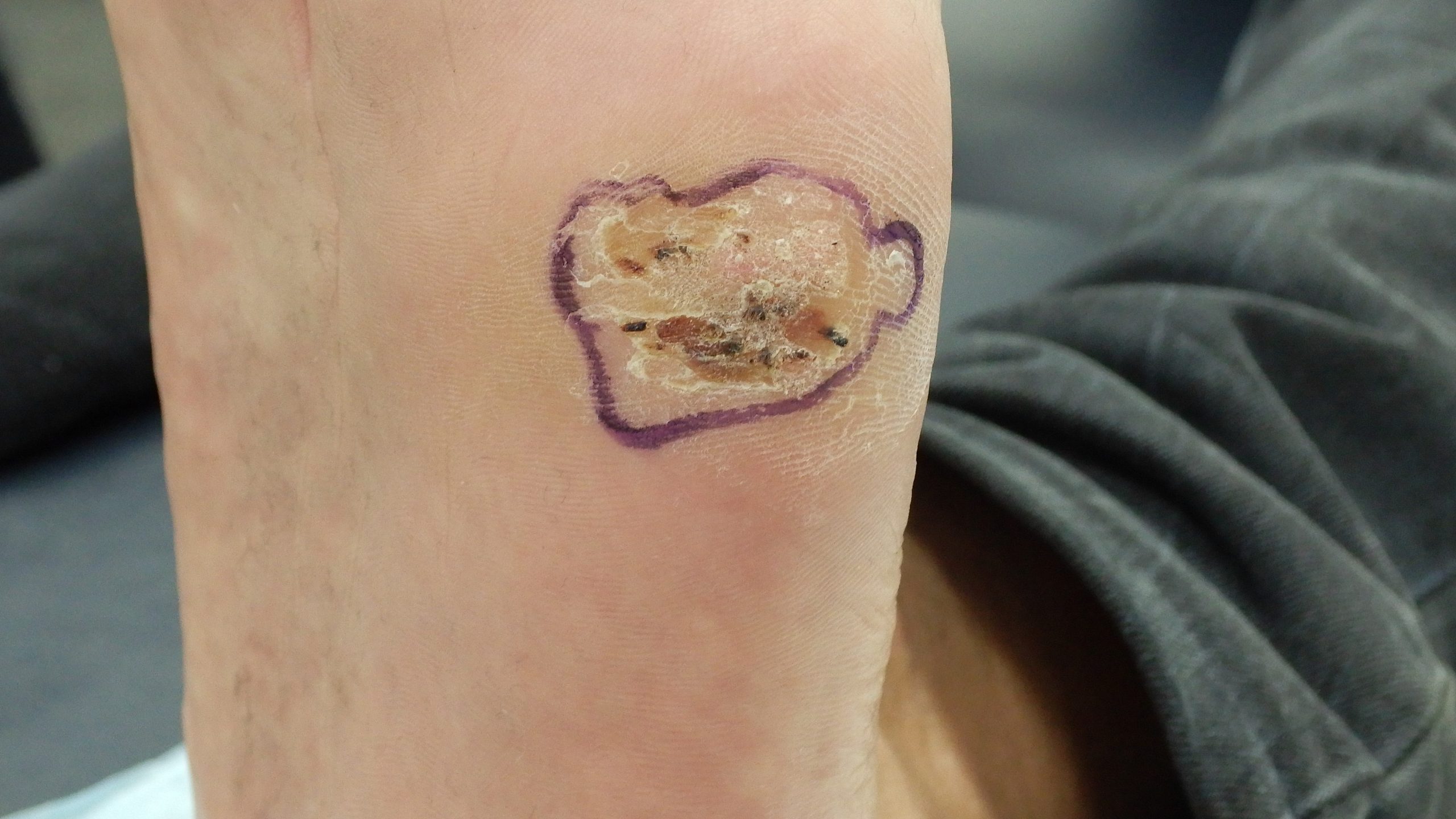 ep 8. Plantar and cutaneous warts