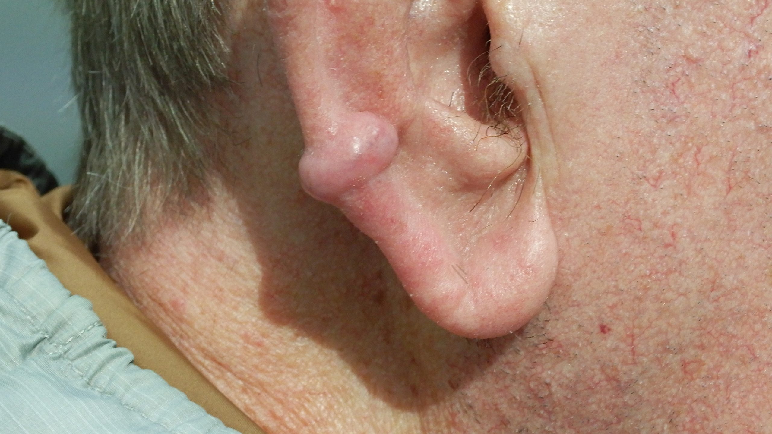 ep 9. JT - consented - keloid scar (use this one instead)