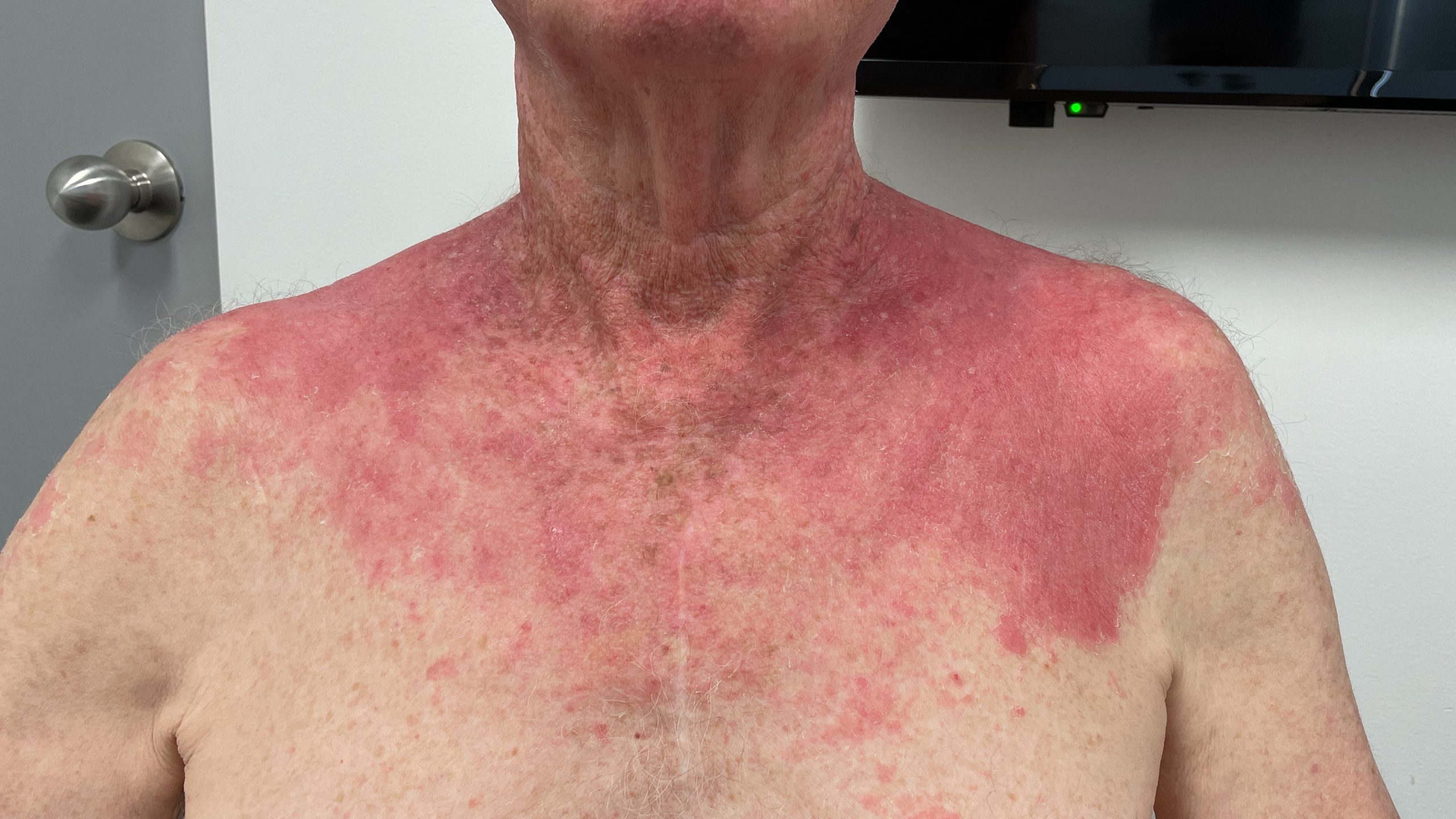 ep 10. Photosensitivity