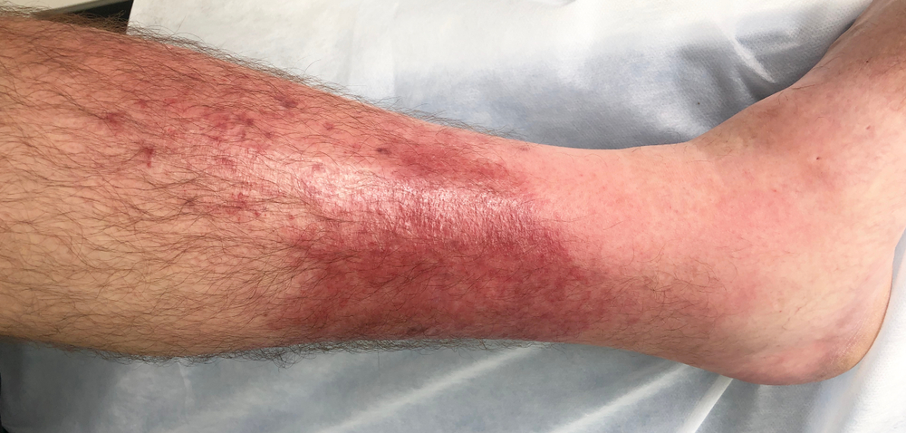 Cellulitis,At,Left,Leg.