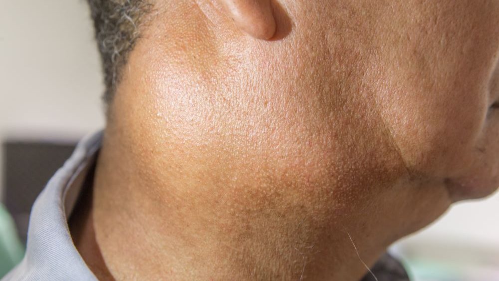 Head and neck lumps_Hero image