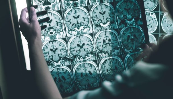 Alzheimer's drug article image