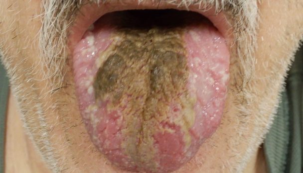 Black hairy tongue