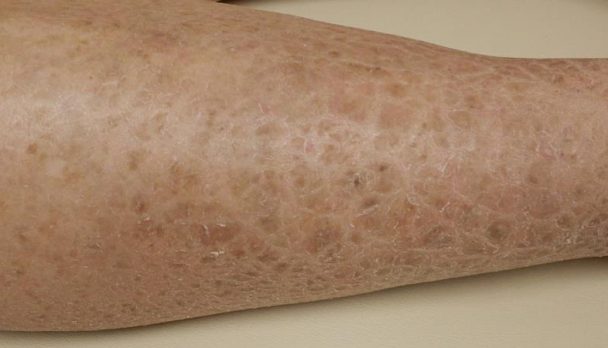 Clinical Quick Quiz - eczema craquele