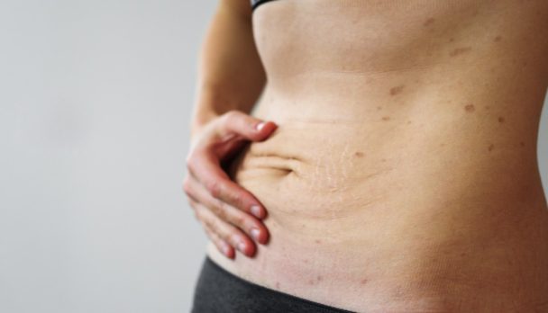CT Health and cosmetic issues related to rapid weight loss