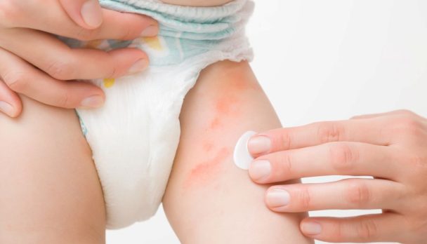 Eczema management course image