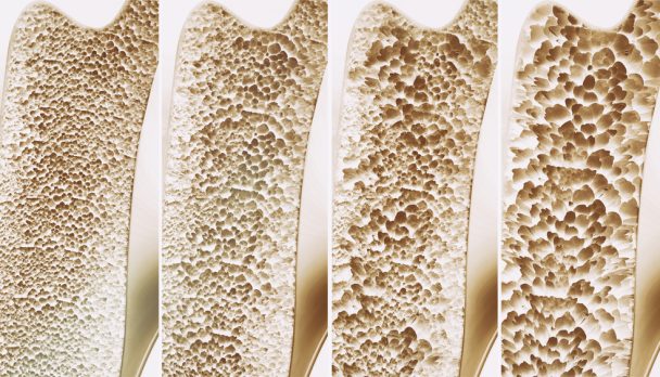 Expert tips and tricks for managing bone health in GP