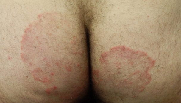 Feb 2025 - tinea