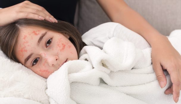 Measles resurgence