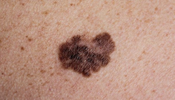 Melanoma,-,A,Malignant,Tumor,Of,The,Skin