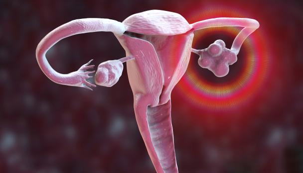 PCOS_3D