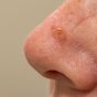 Podcast Feature Img - Actinic keratosis - Fernandez-Penas