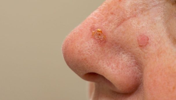 Podcast Feature Img - Actinic keratosis - Fernandez-Penas