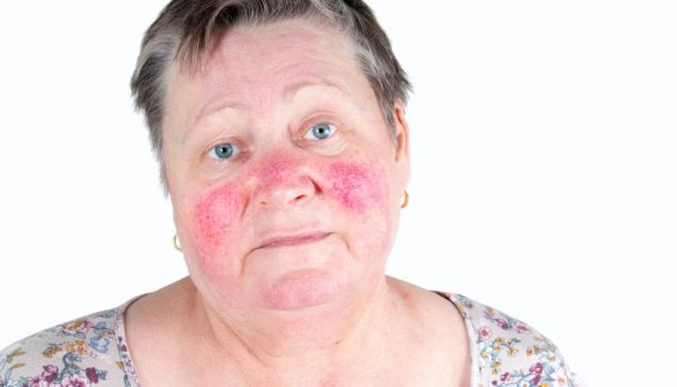 Rosacea hero image