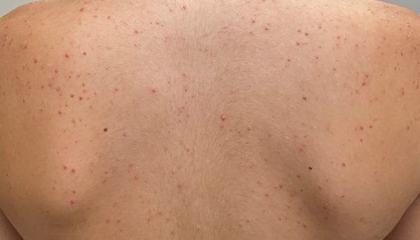 Steroid induced folliculitis img