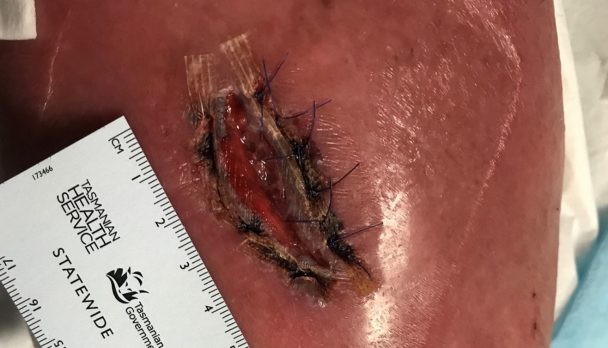 Wound Closure strips outcome