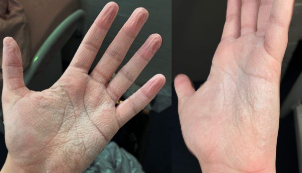 Wrinkling of the palms feature image
