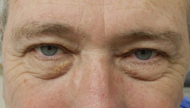 Xanthelasma under eyelids