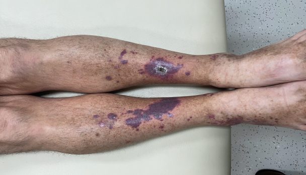 acroangiodermatitis (pseudo-kaposi sarcoma