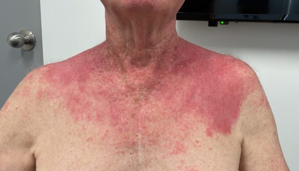 ep 10. Photosensitivity