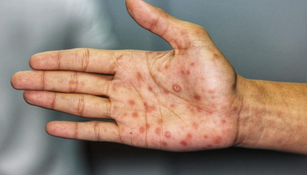 Secondary,Stage,Syphilis,Sores,(lesions),On,The,Palms,Of,The