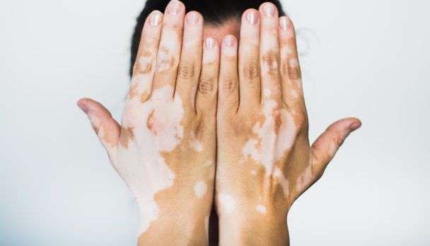 Vitiligo,On,The,Hands,With,White,Background