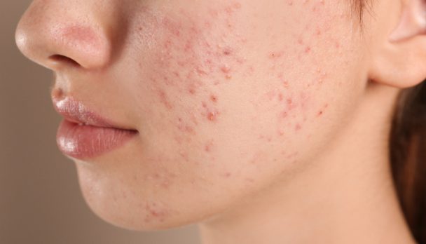 Teenage,Girl,With,Acne,Problem,On,Beige,Background,,Closeup