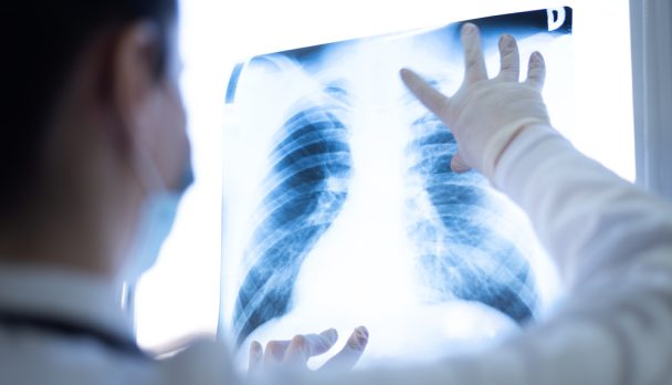 Pulmonologist,Looking,At,Lung,X-ray,Prescribing,Treatment,To,Patient,,Healthcare