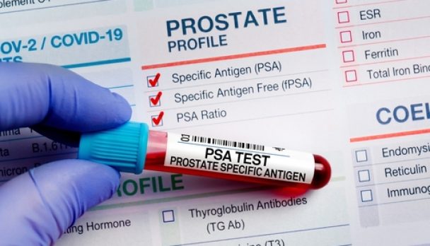 Blood,Sample,Tube,For,Analysis,Of,Psa,Prostate,Specific,Antigen