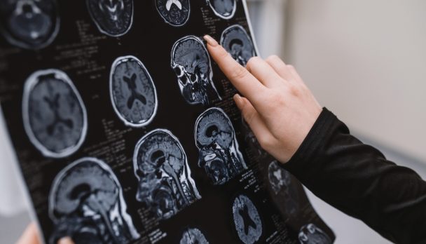 Close-up,Mri,Of,The,Brain,,The,Doctor,Studies,And,Analyzes