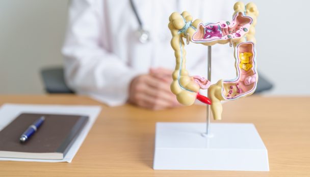 Doctor,With,Human,Colon,Anatomy,Model.,Colonic,Disease,,Large,Intestine,