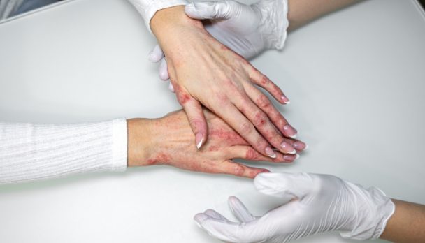 Hands,Showing,Signs,Of,Eczema,,Contact,Dermatitis,,And,Other,Skin