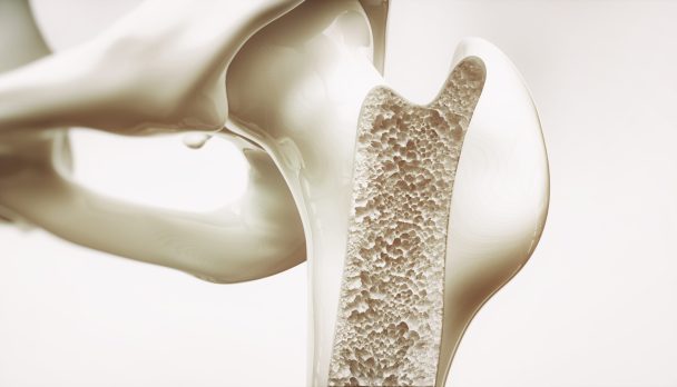 Osteoporosis,Stage,3,Of,4,-,Upper,Limb,Bones,